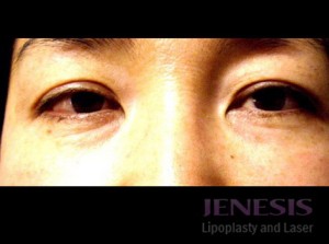 Laser Fatpad Removal