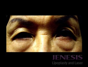 Laser Fatpad Removal