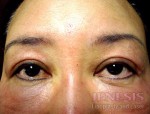 Laser Fatpad Removal