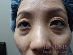 Laser Fatpad Removal