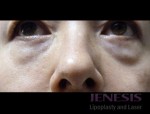 Laser Fatpad Removal