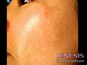 Laser Peel