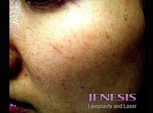 Laser Peel