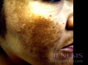 Laser Peel