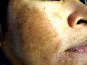 Laser Peel