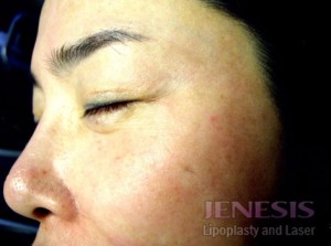 Laser Peel