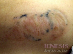 Laser Tattoo Removal