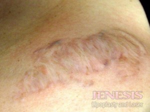 Laser Tattoo Removal