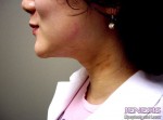 Liposuction Face & Neck