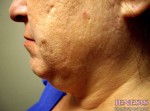 Liposuction Face & Neck