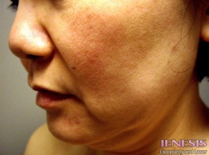 Liposuction Face & Neck