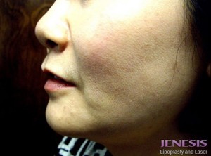 Liposuction Face & Neck