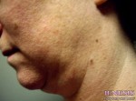 Liposuction Face & Neck