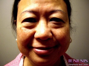 Liposuction Face & Neck