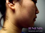 Liposuction Face & Neck