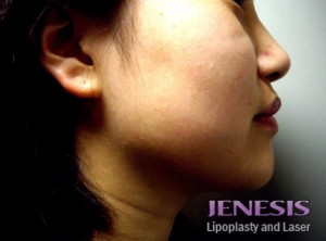 Liposuction Face & Neck