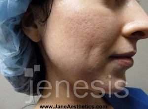 Liposuction Face & Neck