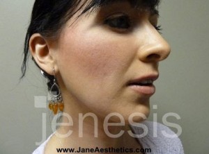 Liposuction Face & Neck