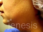 Liposuction Face & Neck