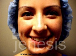 Liposuction Face & Neck