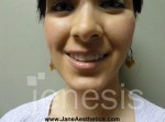 Liposuction Face & Neck