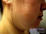 Liposuction Face & Neck