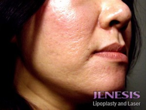 Liposuction Face & Neck