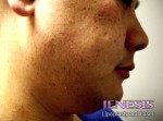 Liposuction Face & Neck