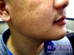 Liposuction Face & Neck