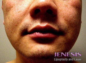 Liposuction Face & Neck