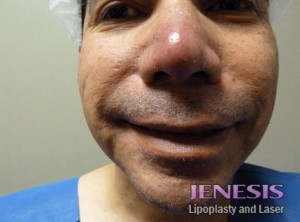 Liposuction Face & Neck