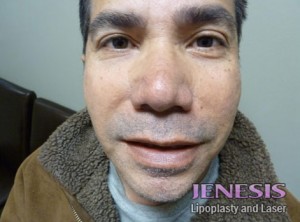 Liposuction Face & Neck