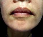 Liquid Face Lift with Botox and Filler