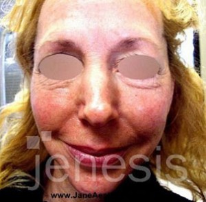 Liquid Face Lift with Botox and Filler