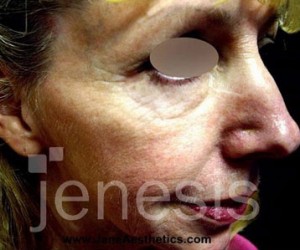 Liquid Face Lift with Botox and Filler