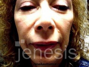Liquid Face Lift with Botox and Filler