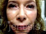 Liquid Face Lift with Botox and Filler