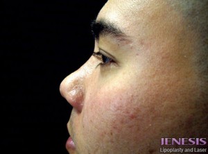 Non Surgical Nose Job