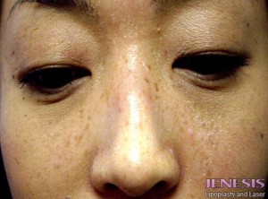 Non Surgical Nose Job