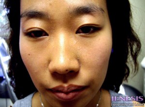 Non Surgical Nose Job