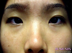 Non Surgical Nose Job