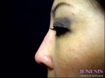 Non Surgical Nose Job