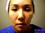 Non Surgical Nose Job