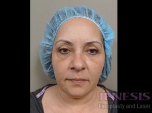 Ultherapy