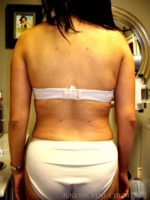 3D Micro Lipo™