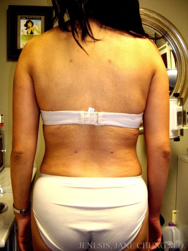 3D Micro Lipo™