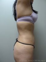 3D Micro Lipo™