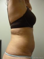 3D Micro Lipo™