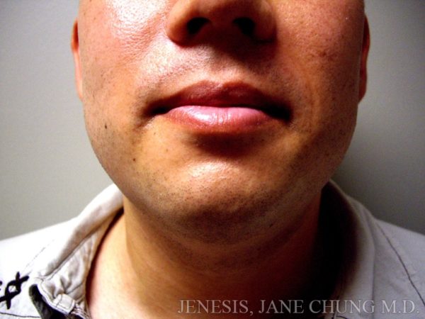Liposuction Face & Neck
