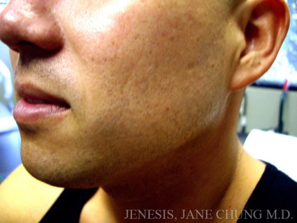 Liposuction Face & Neck